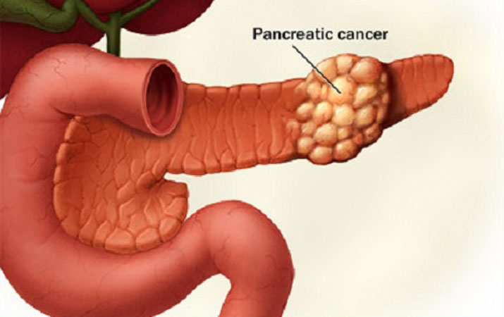 Внимавајте, ова се рани симптоми на рак на панкреас!