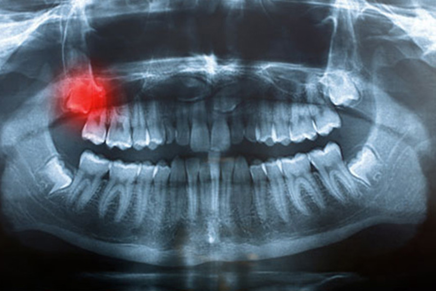 Заболените од рак претходно ги имале овие проблеми со забите!