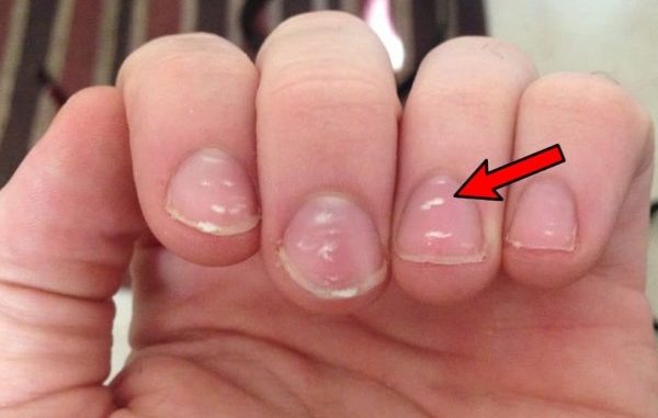 Што значат белите дамки на ноктите?