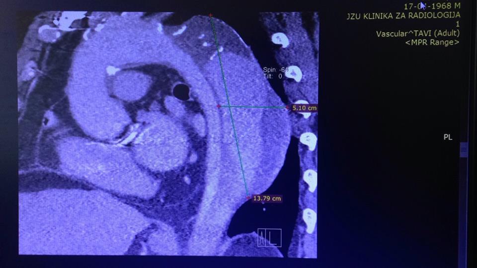 За прв пат во Македонија на Државната кардиохирургија направени операции кај двајца пациенти со тешка патологија на аортата