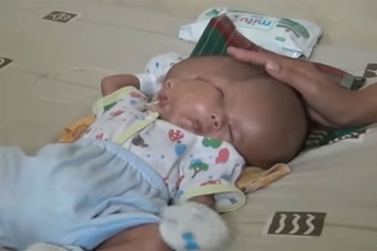 Чудо кое се јавува еднаш во 2,5 милиони случаи – Родено бебе со два мозоци и две лица!