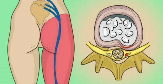 Како да се отклешти вклештен нерв во лумбалниот дел од грбот (ишијас): 2 едноставни начини