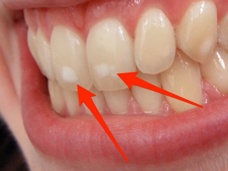 Бели дамки на забите, зошто некои луѓе ги имаат, а други не?