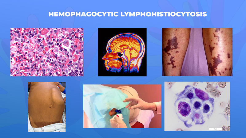 Ги запознаваме ретките болести: Хемофагоцитната лимфохистиоцитоза