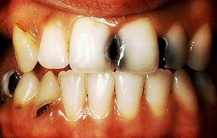 Истражување: Главен причинител за расипување на забите е бактеријата Selenomonas sputigena